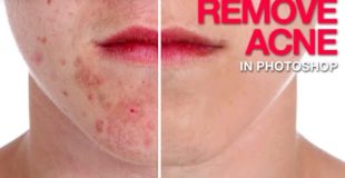 How to Remove Acne in Photoshop